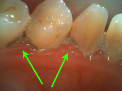 スケーリング中