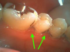 スケーリング後