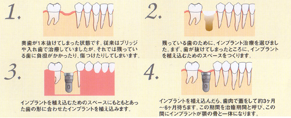 インプラント治療
