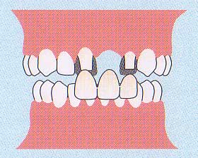 前歯部一本欠損