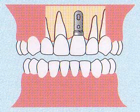 前歯部一本欠損