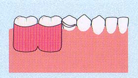 臼歯部から歯が欠損している場合（遊離端）