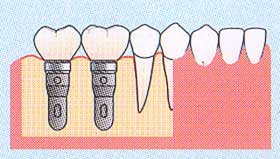 臼歯部から歯が欠損している場合（遊離端）