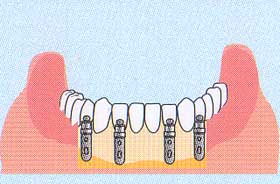 完全に歯がない場合