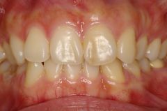 オールセラミック