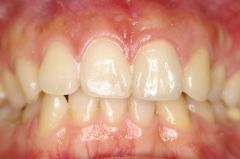 オールセラミック