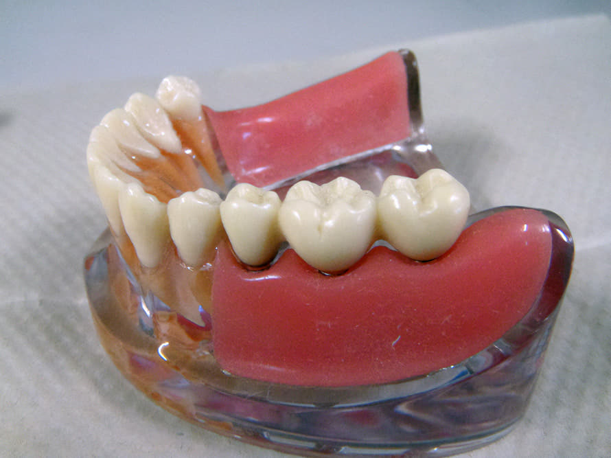 インプラント模型