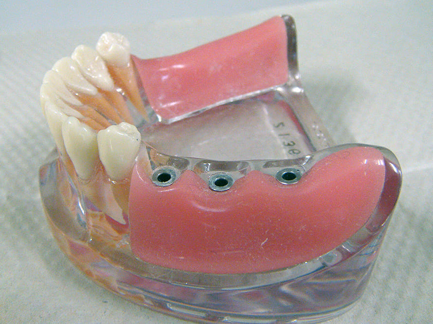 インプラント模型