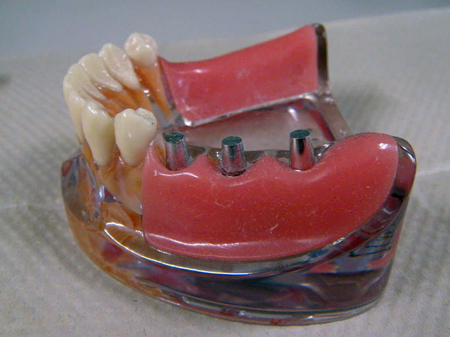 インプラント模型