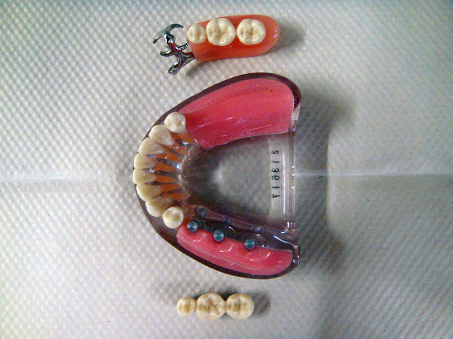 インプラント模型