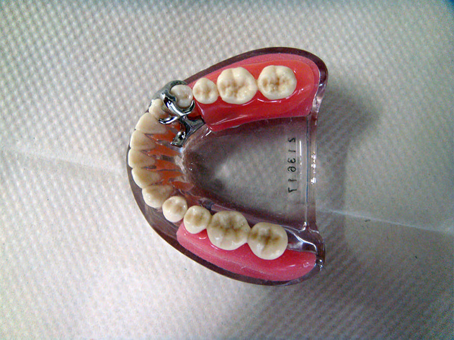 インプラント模型