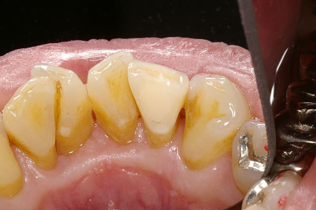 歯牙の漂白（Walking Breach法）