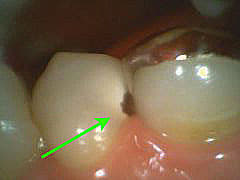 いろいろな虫歯