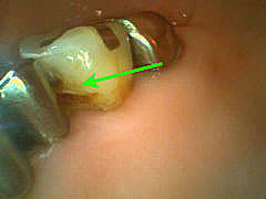 いろいろな虫歯