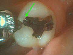 いろいろな虫歯