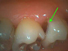 いろいろな虫歯