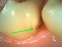 いろいろな虫歯