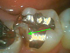 いろいろな虫歯