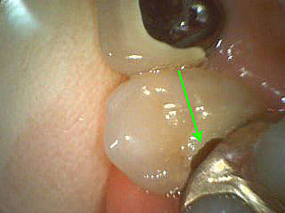 いろいろな虫歯