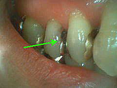 いろいろな虫歯