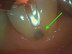 いろいろな虫歯