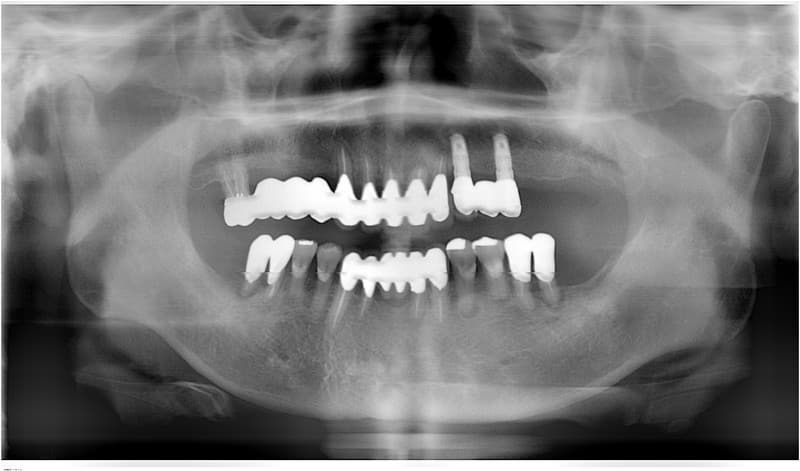 インプラント-術後2年-ケース1-2