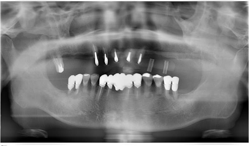 インプラント-審査-ケース1-2