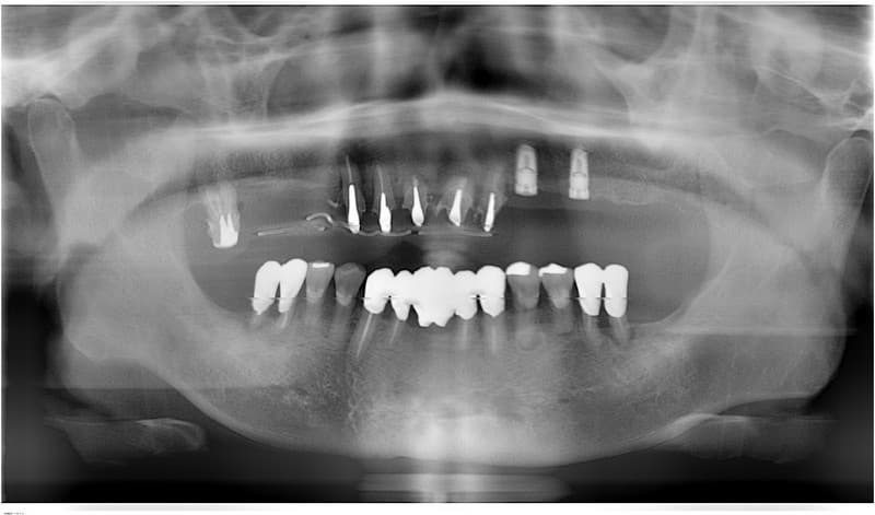インプラント-埋入-ケース1-2