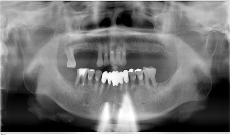 インプラント-術前-ケース1-2