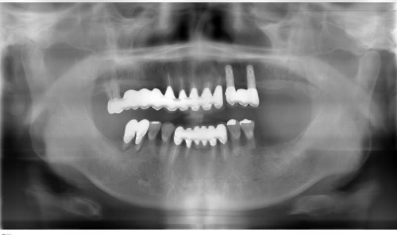 インプラント-術後6年-ケース1-2